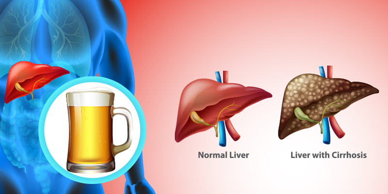 Bệnh là tình trạng mỡ tích tụ bên trong tế bào gan.