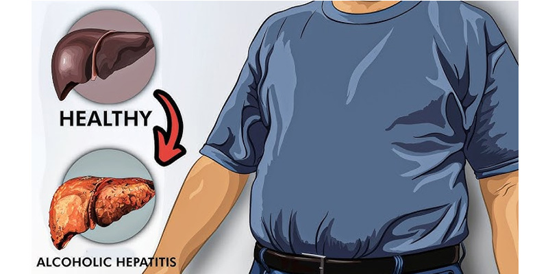 Gan nhiễm mỡ gồm hai nhóm chính là gan nhiễm mỡ do rượu và không do rượu