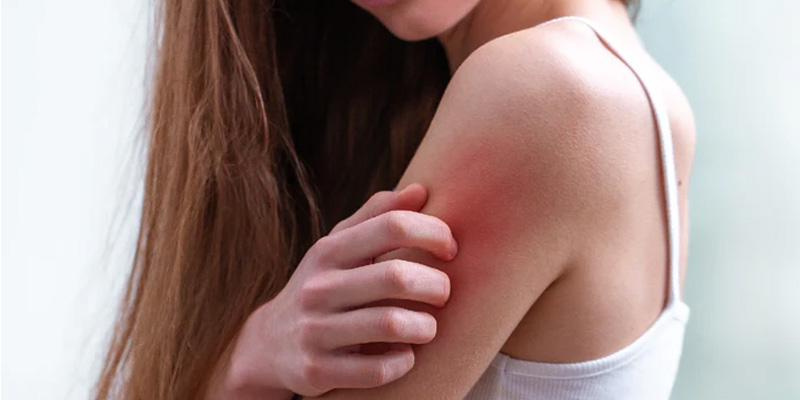 Sẩn ngứa do gan thường xuất hiện ở giai đoạn muộn của bệnh khi gan đã bị tổn thương lâu dài