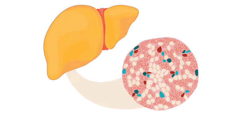 Tỷ lệ người bị gan nhiễm mỡ hiện nay ngày càng tăng cao