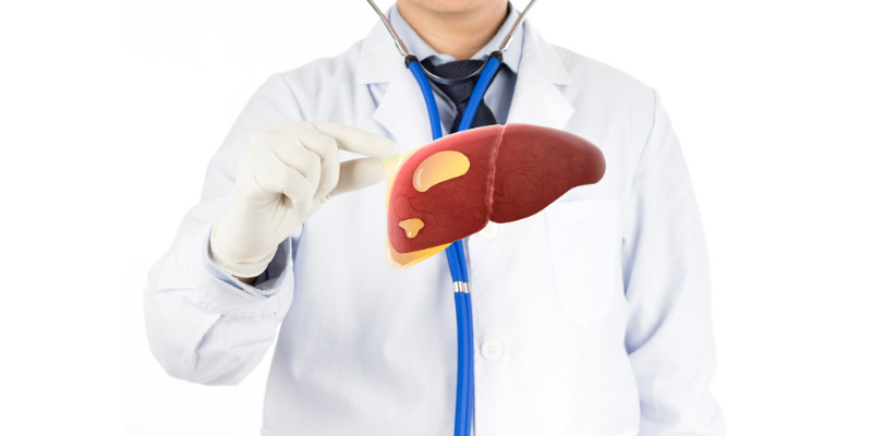 Gan nhiễm mỡ nhẹ là khi lượng mỡ thừa khoảng 5-10% trong tế bào gan