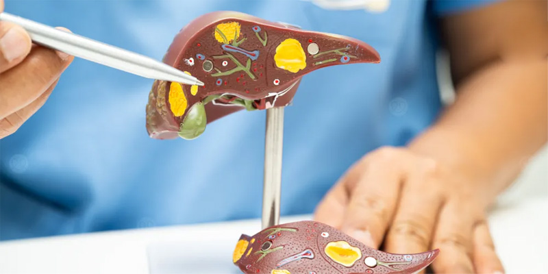 Gan nhiễm mỡ ở người già được gây ra bởi nhiều nguyên nhân