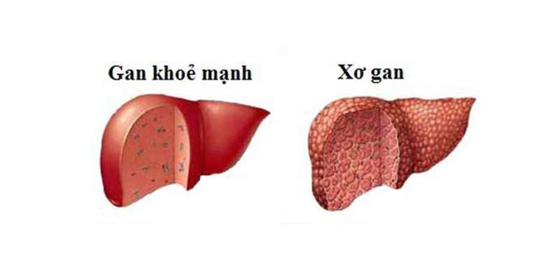 Gan nhiễm mỡ hạn chế sản xuất apoprotein, tạo điều kiện cho chất béo đi vào gan nhiều hơn