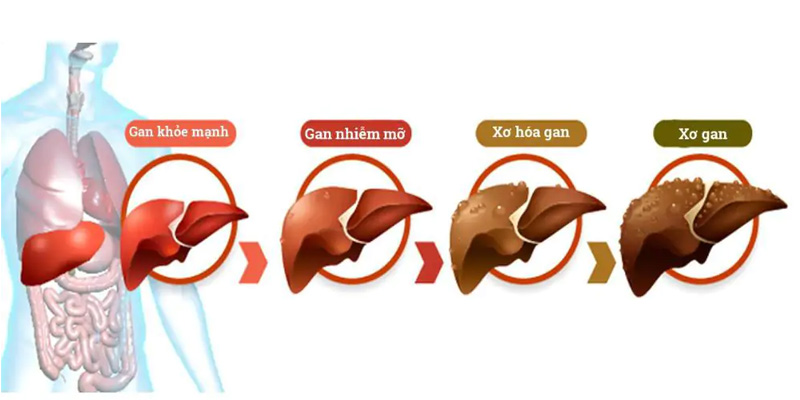 Gan nhiễm mỡ gây ra các biến chứng như viêm gan, xơ gan và các bệnh về gan