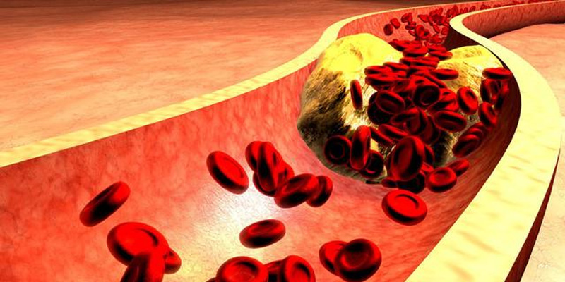 Bệnh mỡ máu không có triệu chứng rõ ràng nên khó phát hiện