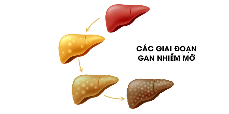 Bệnh gan nhiễm mỡ được chia thành ba cấp độ khác nhau từ 1 đến 3