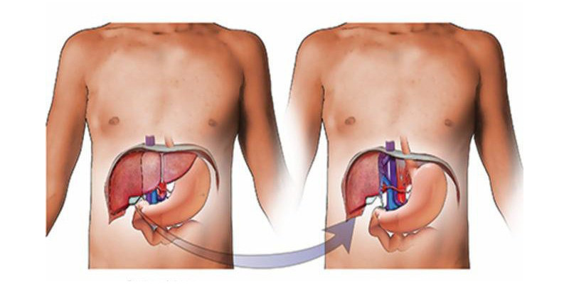 Ghép gan là một trong những phương pháp điều trị ung thư gan giai đoạn 2