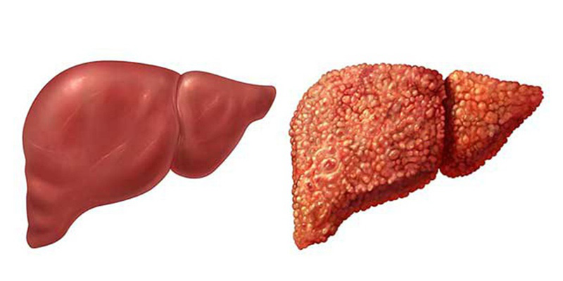 Giai đoạn 4 gan bị tổn thương nặng nề