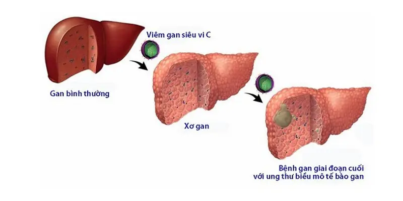 Giai đoạn bệnh ảnh hưởng đến chi phí điều trị viêm gan C