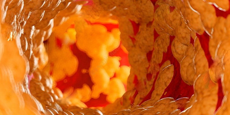 Điều trị mỡ máu giúp kiểm soát tình trạng gan nhiễm mỡ