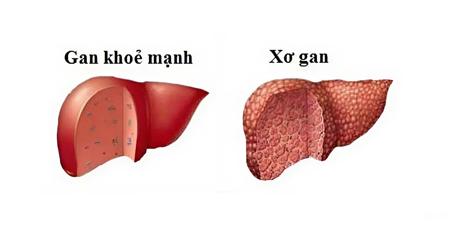 Viêm gan B cấp tính có thể chuyển sang viêm gan B mãn tính 