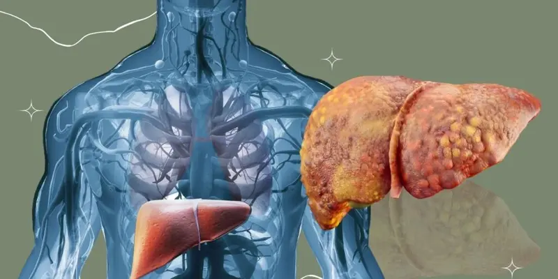 Gan thấm mỡ là một trong các bệnh lý phổ biến và vô cùng nguy hiểm