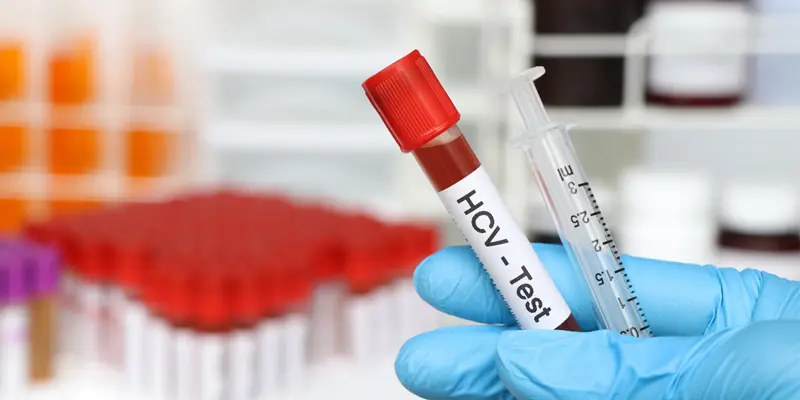 Kiểm tra kháng thể HCV cần tiến hành xét nghiệm viêm gan C