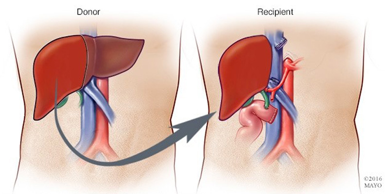 Phẩu thuật ghép gan là giải pháp cuối cùng hỗ trợ điều trị gan nhiễm mỡ tiến triển nặng
