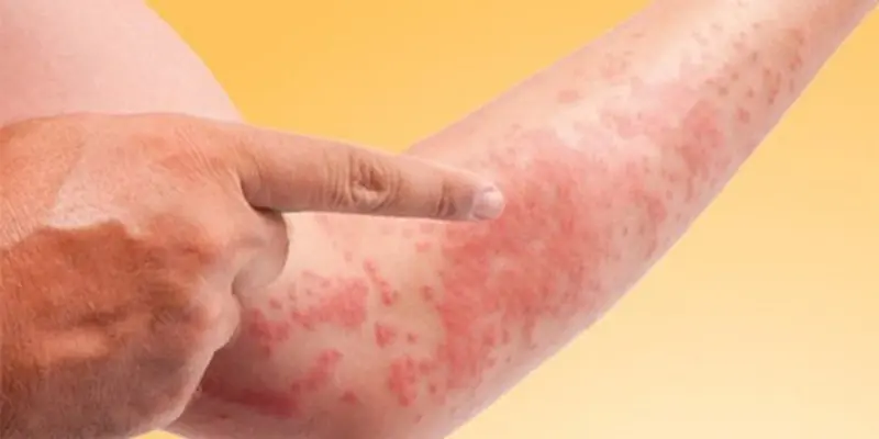 Người có cơ địa nhạy cảm có thể uống thuốc giải độc gan bị ngứa