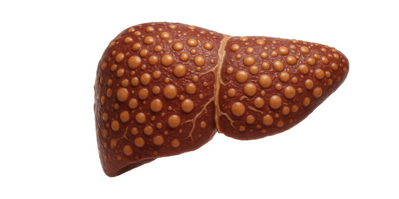 Men gan cao khi bị tổn thương các enzyme sẽ thiast ra ngoài khiến men gan tăng cao