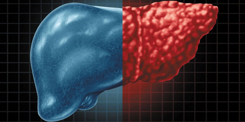 Có khoảng 7% đến 10% người gầy mắc bệnh gan nhiễm mỡ