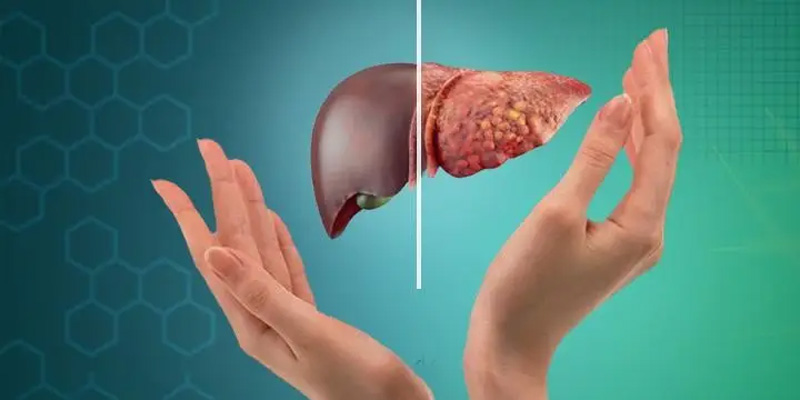 gan nhiễm mỡ không do rượu à một trong những bệnh gan mạn tính phổ biến