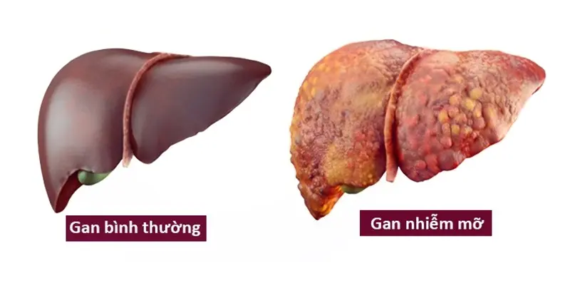 Gan nhiễm mỡ là tình trạng có sự tăng mức mỡ trong các tế bào gan