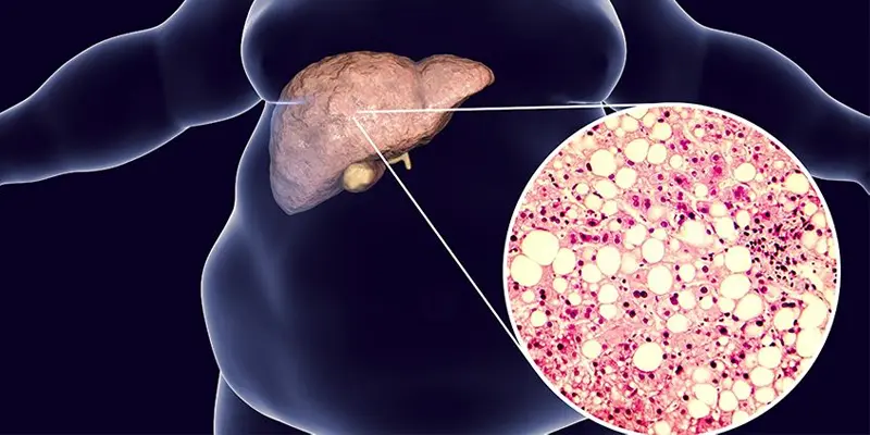 Người béo phì là đối tượng có nguy cơ cao gan bị nhiễm mỡ