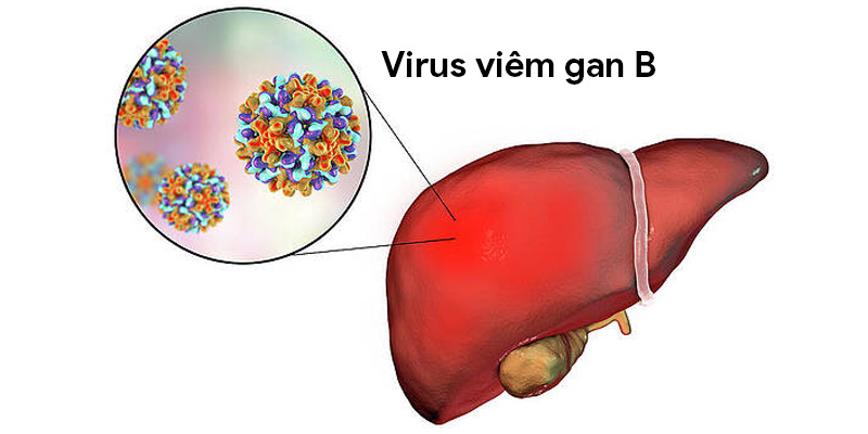 Viêm gan B là một trong những nguyên nhân ung thư gan hàng đầu