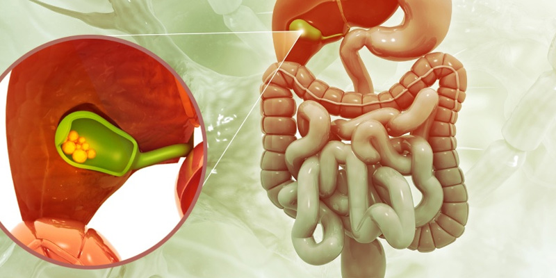 Sỏi mật là nguyên nhân phổ biến gây tắc mật ngoài gan