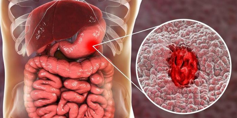 Áp lực tại các tĩnh mạch cửa tăng cao làm vỡ tĩnh mạch thực quản