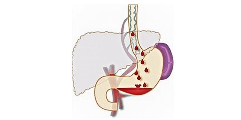 Giãn tĩnh mạch thực quản thường có triệu chứng khi tĩnh mạch bị vỡ và chảy máu
