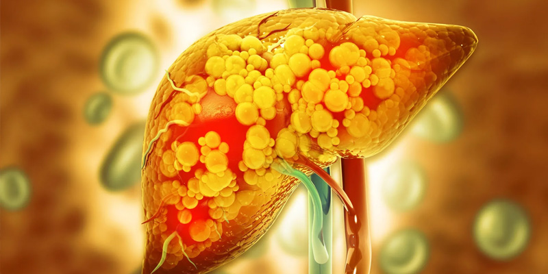 Gan nhiễm độc là tình trạng tổn thương ở gan, dẫn tới viêm