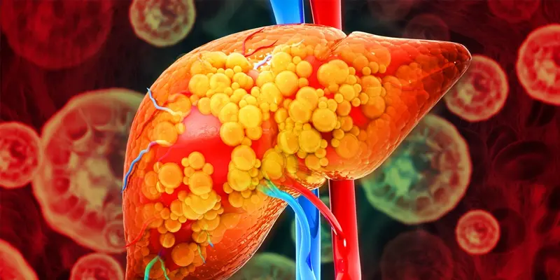 Nhiều người thắc mắc bệnh chai gan có nguy hiểm không