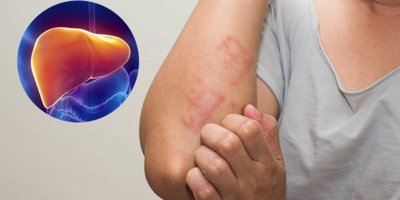 Ngứa có thể là dấu hiệu của gan bạn đang bị nóng