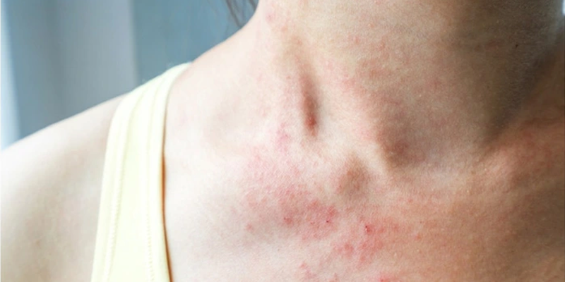 Gan không hoạt động tốt gây nóng gan nổi mụn ngứa
