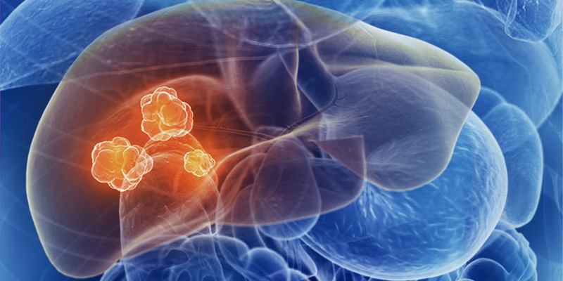 Phương pháp nút mạch gan theo cơ chế loại bỏ nguồn nuôi dưỡng khối u và tiêu diệt khối u