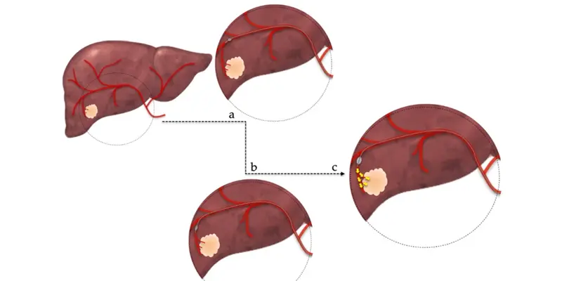 Nút mạch ung thư gan là phương pháp điều trị ung thư gan tiên tiến, hiệu quả