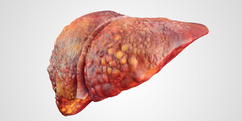 Khi chẩn đoán được bệnh, bác sĩ sẽ lựa chọn phác đồ điều trị xơ gan hợp lý