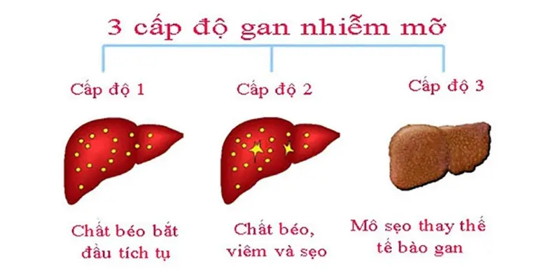 Bệnh gan nhiễm mỡ gồm 3 cấp độ chính