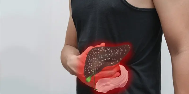 Xơ gan ứ mật là tình trạng mật bị ứ đọng, khiến gan bị tổn thương và gây ra xơ gan.