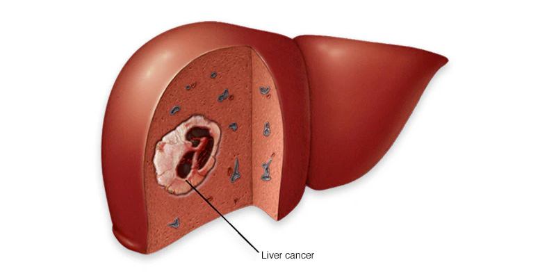 Phẫu thuật cắt gan nhằm loại bỏ các khối u trong gan