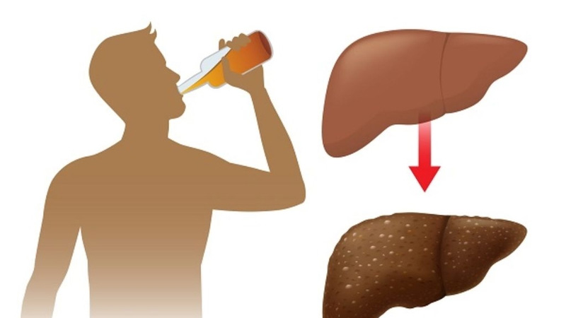 Hạn chế rượu bia để bảo vệ chức năng gan khoẻ mạnh