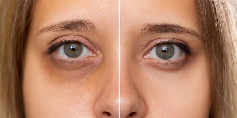 Mí mắt có thể trở nên mềm, sưng hoặc làm khô giác mạc nếu điều trị kéo dài