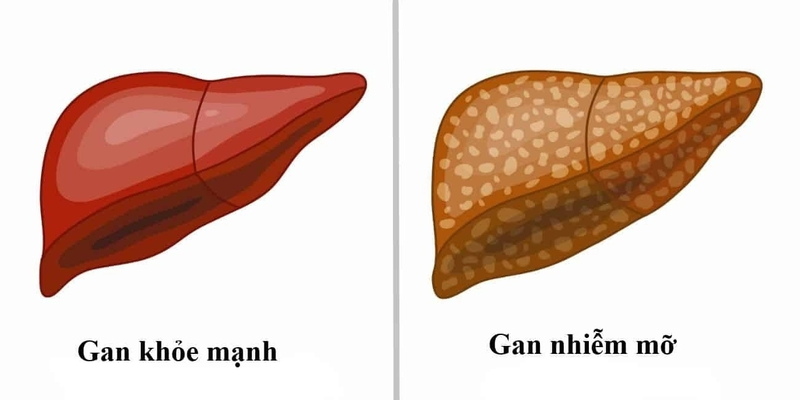 Gan nhiễm mỡ khi lượng mỡ tăng lên tới 5 - 10%