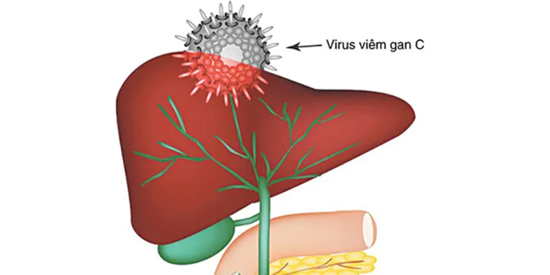 Tại sao gan bị khô? Cơ chế gây tổn thương gan