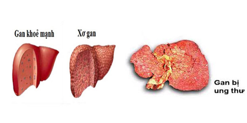 Ung thư gan đứng thứ 4 trên thế giới về số ca mắc tại nước ta