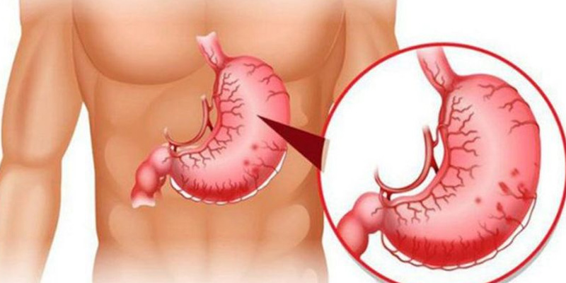 Tăng áp lực tĩnh mạch cửa