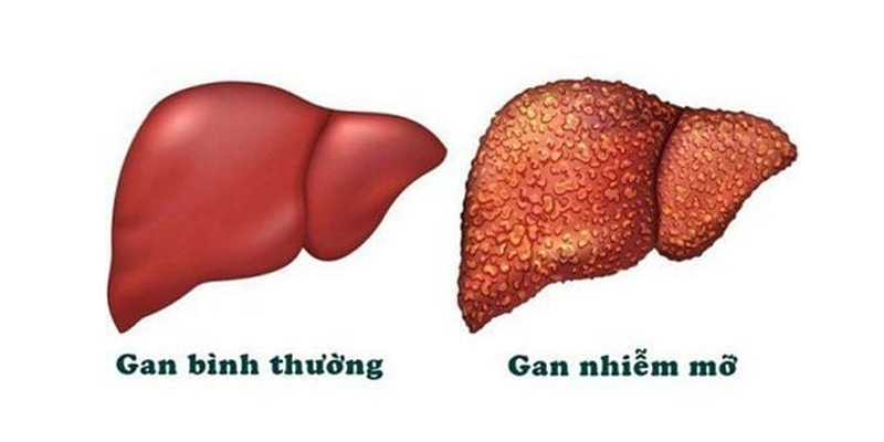 Chế độ ăn uống đóng vai trò quan trọng trong quá trình điều trị bệnh gan nhiễm mỡ