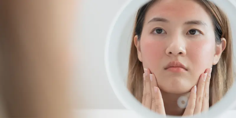 Thuốc Orib 200mg có thể gây ra những tác dụng phụ như khô da, ngứa,...