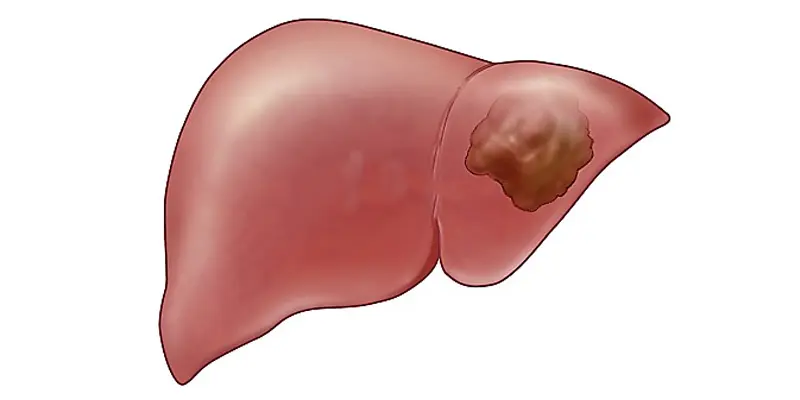 Thuốc&nbsp;Sorakaso 200mg (Sorafenib) được chỉ định trong những trường hợp ung thư biểu mô tế bào gan,...