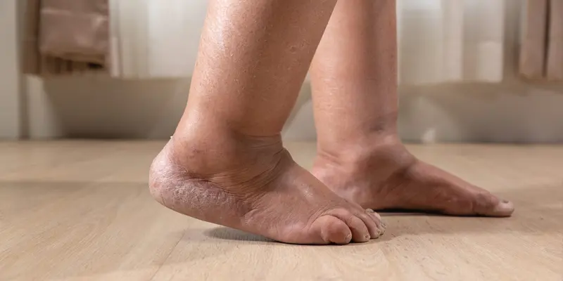 Tình trạng phù chân ở người bệnh