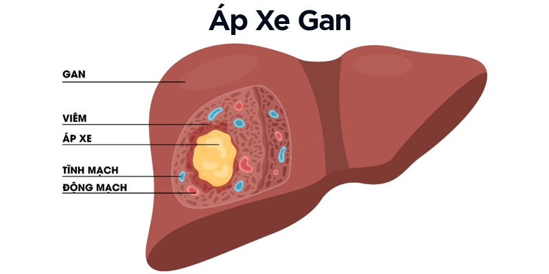 Áp xe gan là tình trạng nhiễm trùng ở gan thường gặp do vi khuẩn, ký sinh trùng gây ra