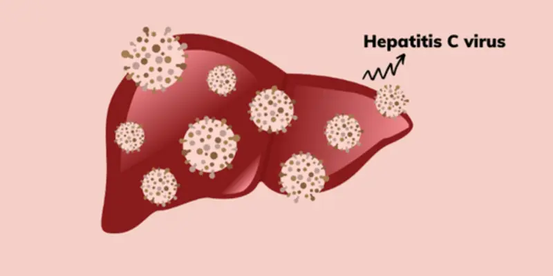 Tổng quan về bệnh viêm gan C cấp tính